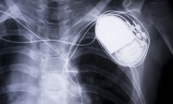 FDA: 465,000 Pacemakers need a firmware update